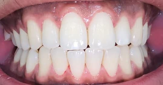 Teeth Whitening After