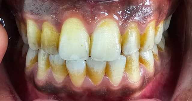 Teeth Whitening Before